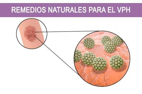 Remedios Naturales para el VPH